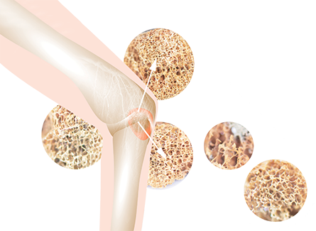 Bone Up on Osteoporosis