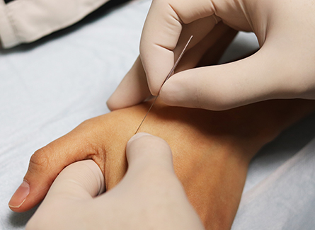 Acupuncture