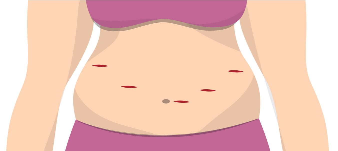 Diagram of marks on stomach from laparoscopic surgery