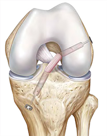 TightRope ABS ACL Reconstruction